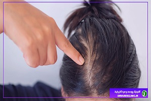 ریزش مو یا آلوپسی چیست؟ از سیر تا پیاز ریزش مو