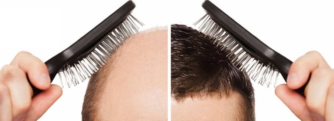 25 اصطلاح پرکاربرد که  در کاشت مو استفاده می شود