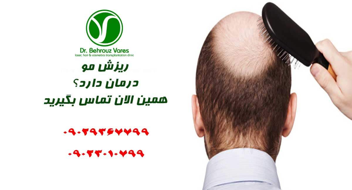 درمان ریزش مو  در شیراز